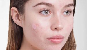 Cara Betul Guna Color Corrector Untuk Parut Jerawat